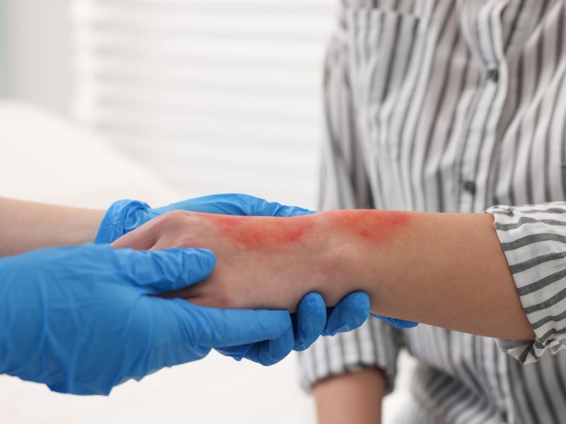 Immediate First Aid Tips for Minor Skin Burns