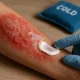 Recognizing Skin Burn Severity and Applying First Aid