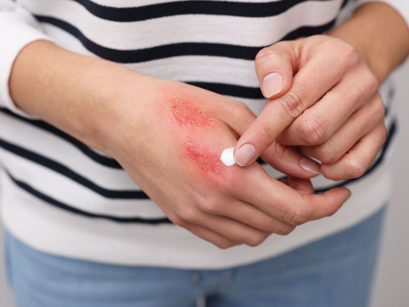 Why First Degree Burns Teach Us More About Healing