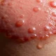 What Most People Miss When Dealing With First Degree Burn