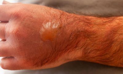 When Quick Thinking Matters Most: Dealing With First Degree Burn