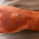 When Quick Thinking Matters Most: Dealing With First Degree Burn