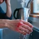 Why Dealing With First Degree Burn Begins With Your Mind