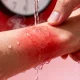 Why Dealing With First Degree Burn Starts Before the Pain