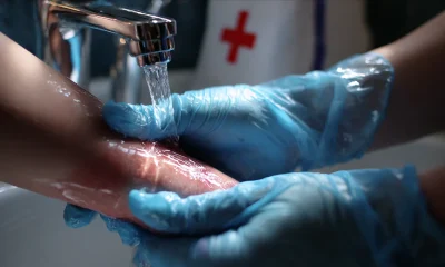 Dealing With Burns Using Proper First Aid Steps