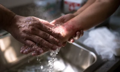 When Skin Meets Fire: First Aid Steps That Save You
